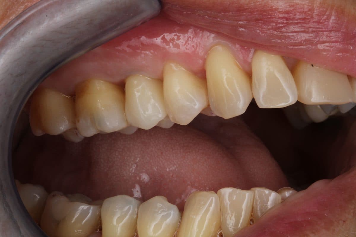 Full row of teeth restored on dental implants