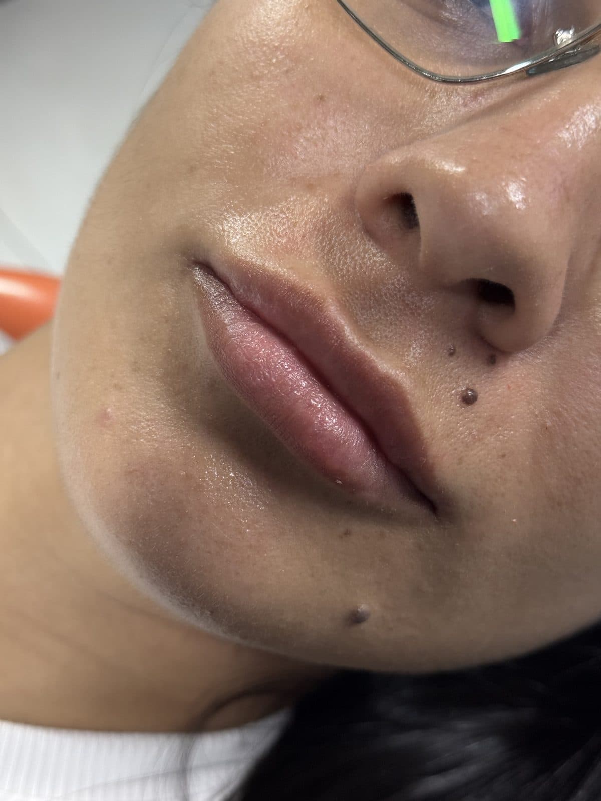 Noticeably fuller lips after volume enhancement