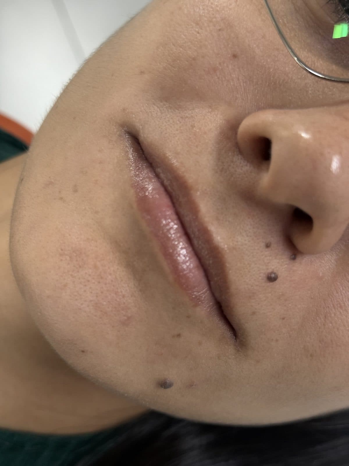 Lips before volume enhancement