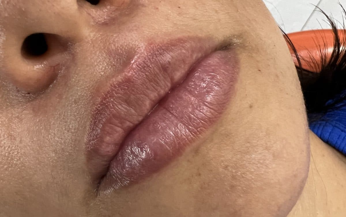 Fuller defined lips after augmentation