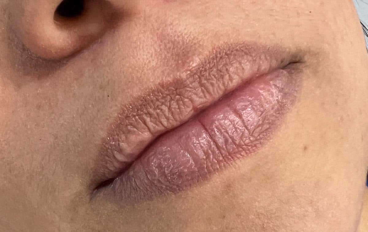 Natural thin lips before augmentation