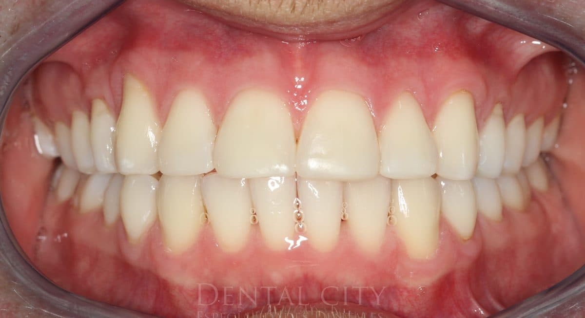 Brighter whiter teeth after professional whitening