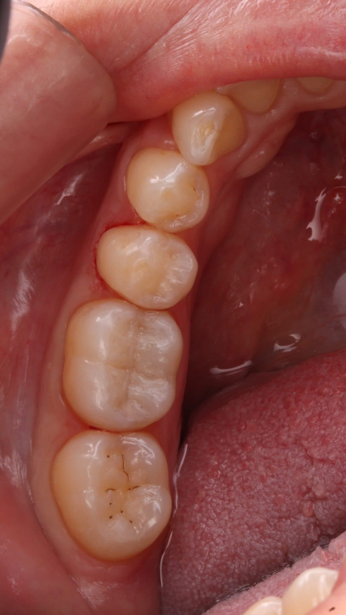 Natural tooth-colored composite restorations