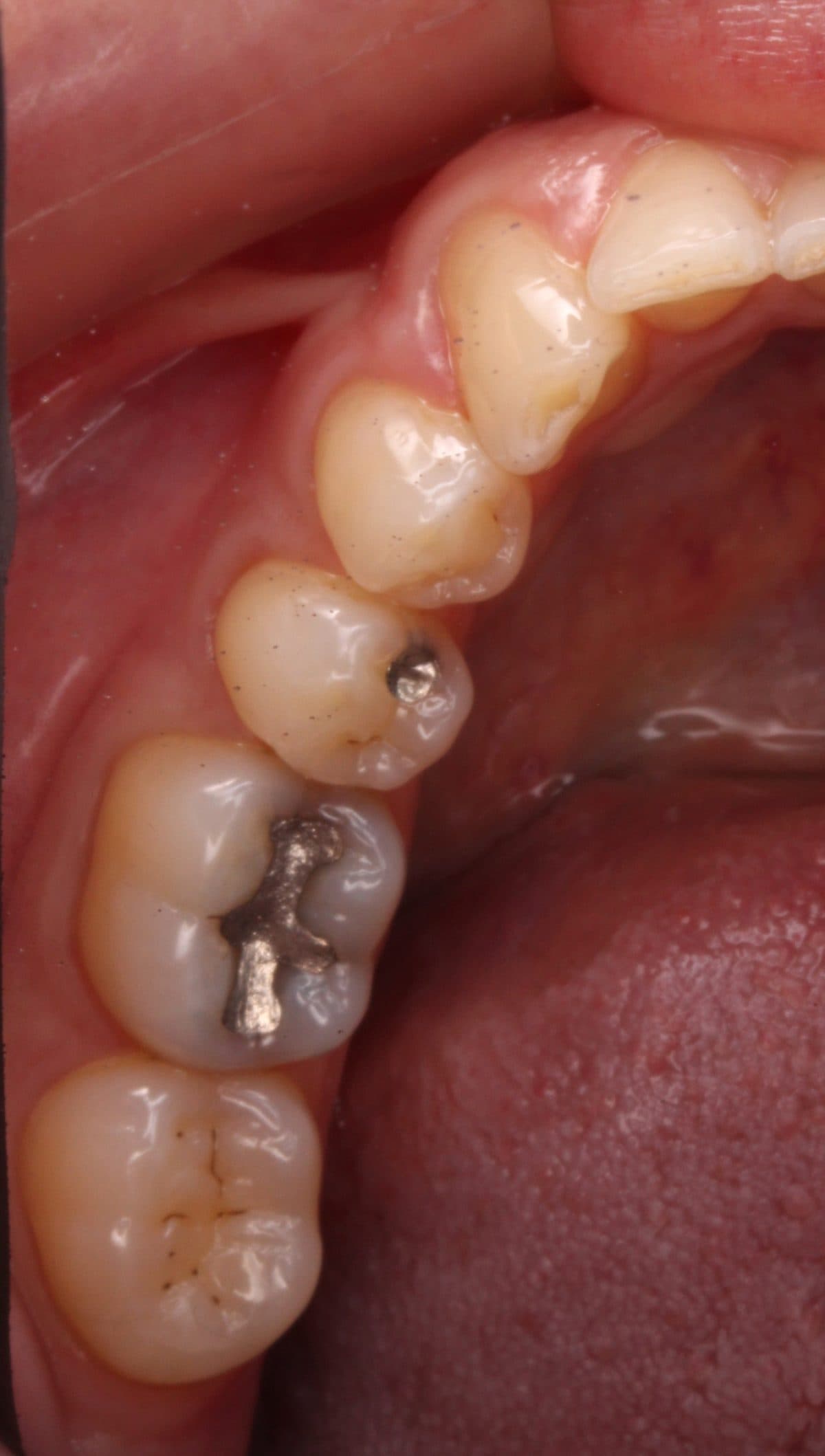 Dark silver amalgam fillings