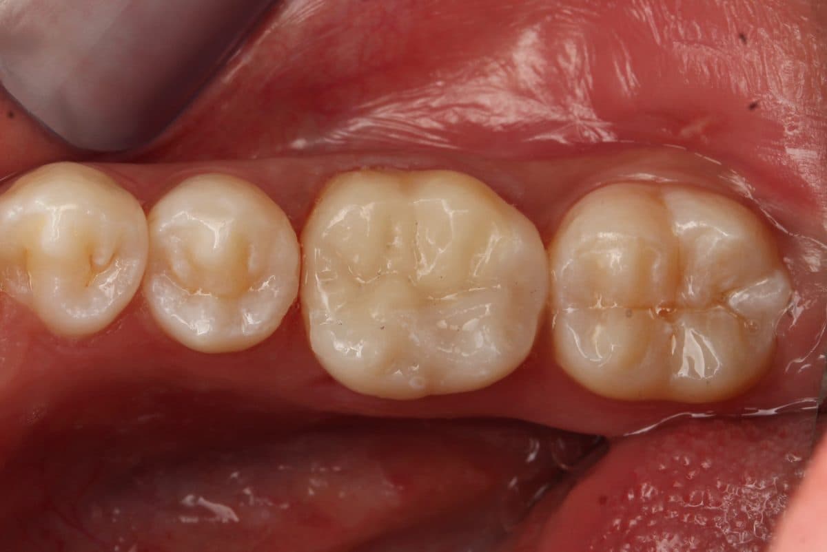 Fresh natural composite filling