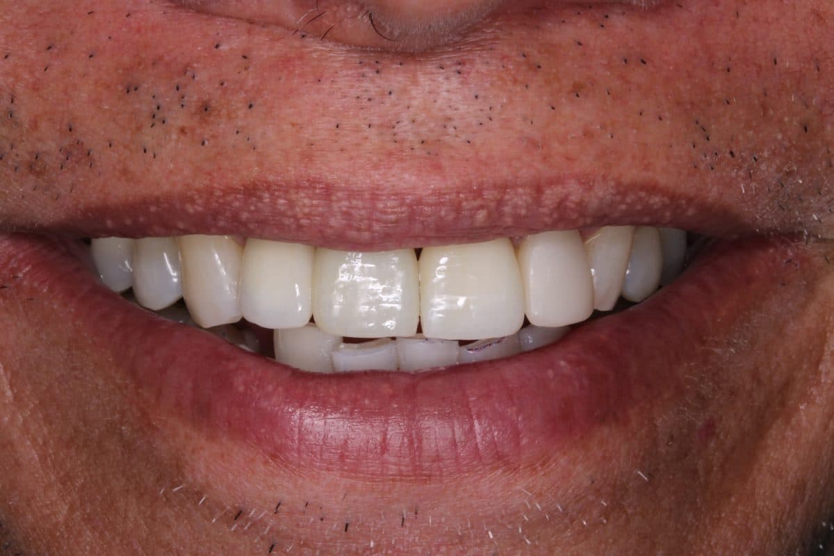 Restored teeth after comprehensive treatment
