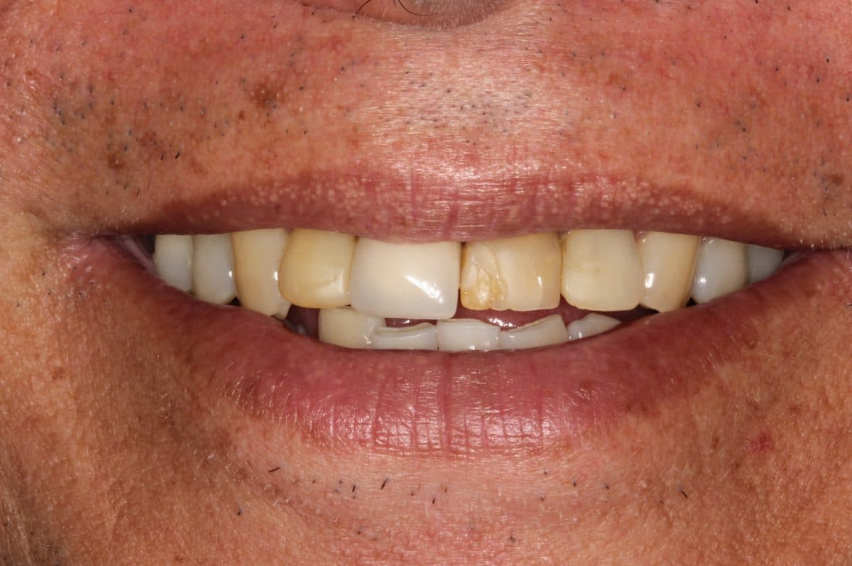 Broken stained teeth before restoration