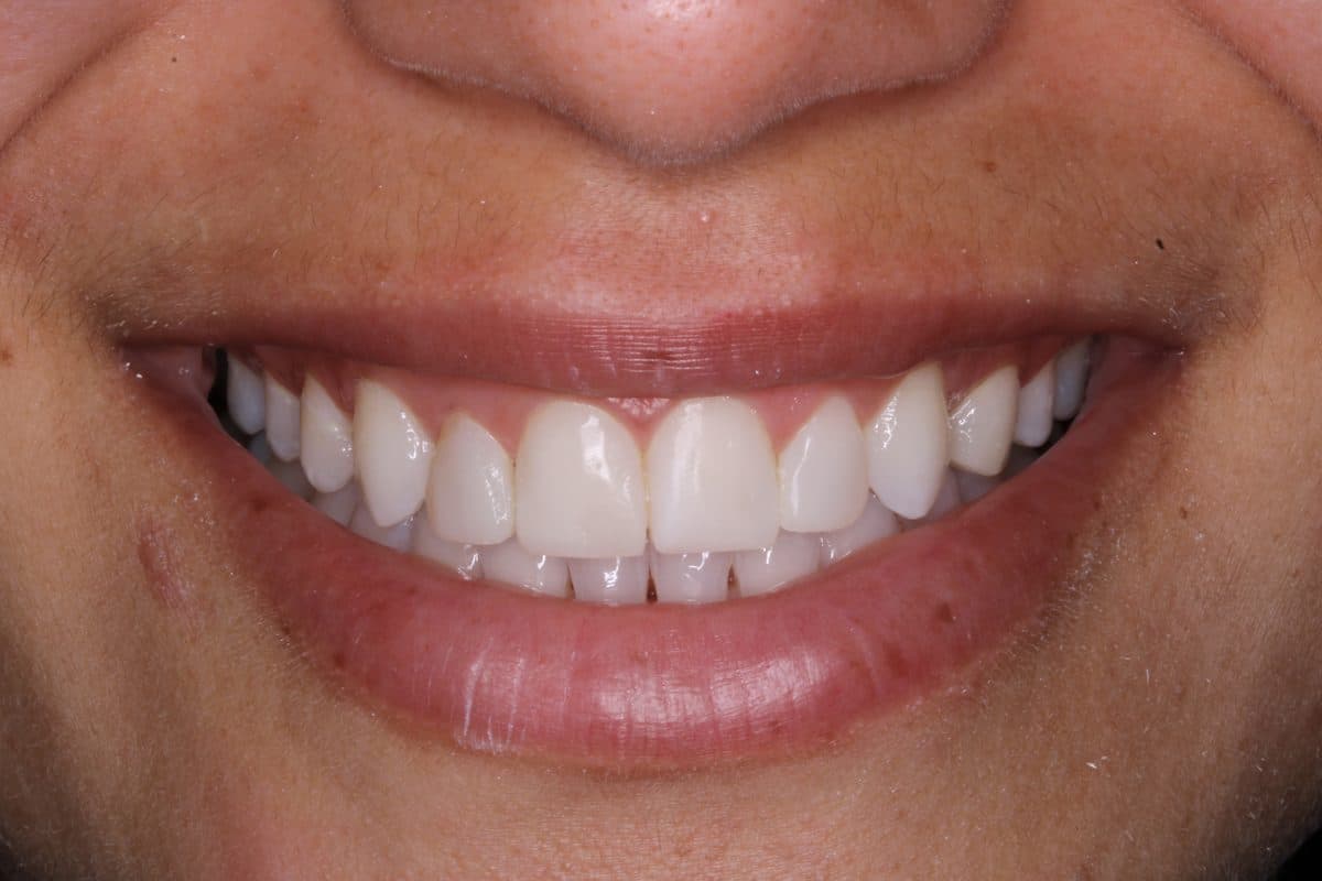 Beautifully aligned uniform smile after treatment
