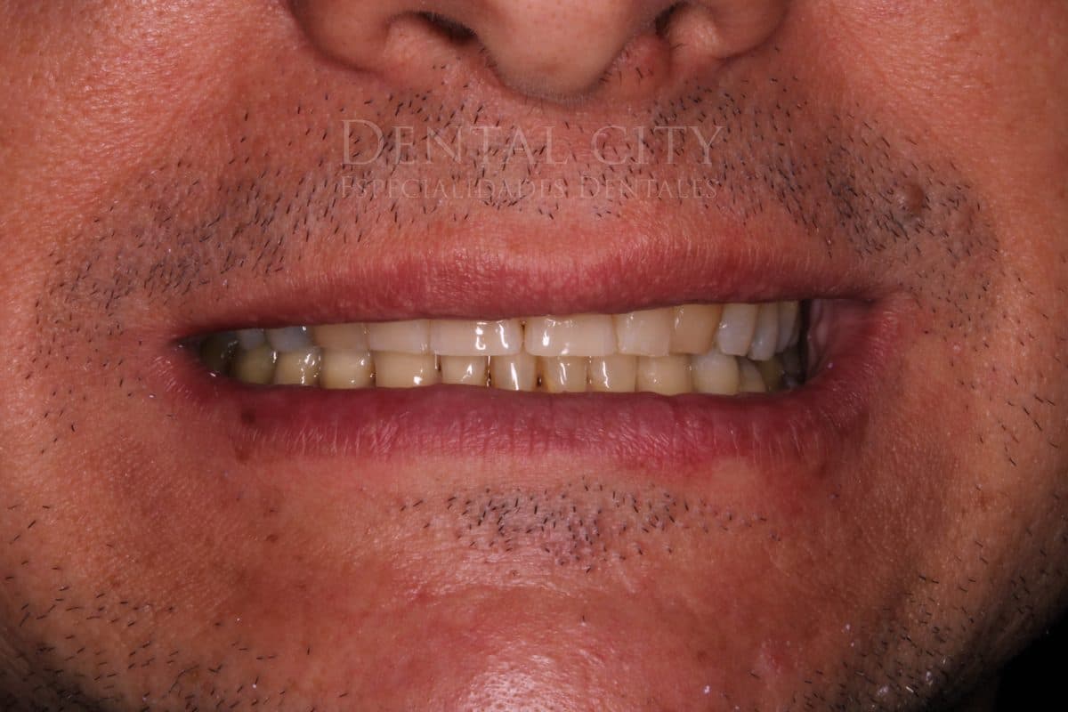 Worn stained teeth before smile makeover