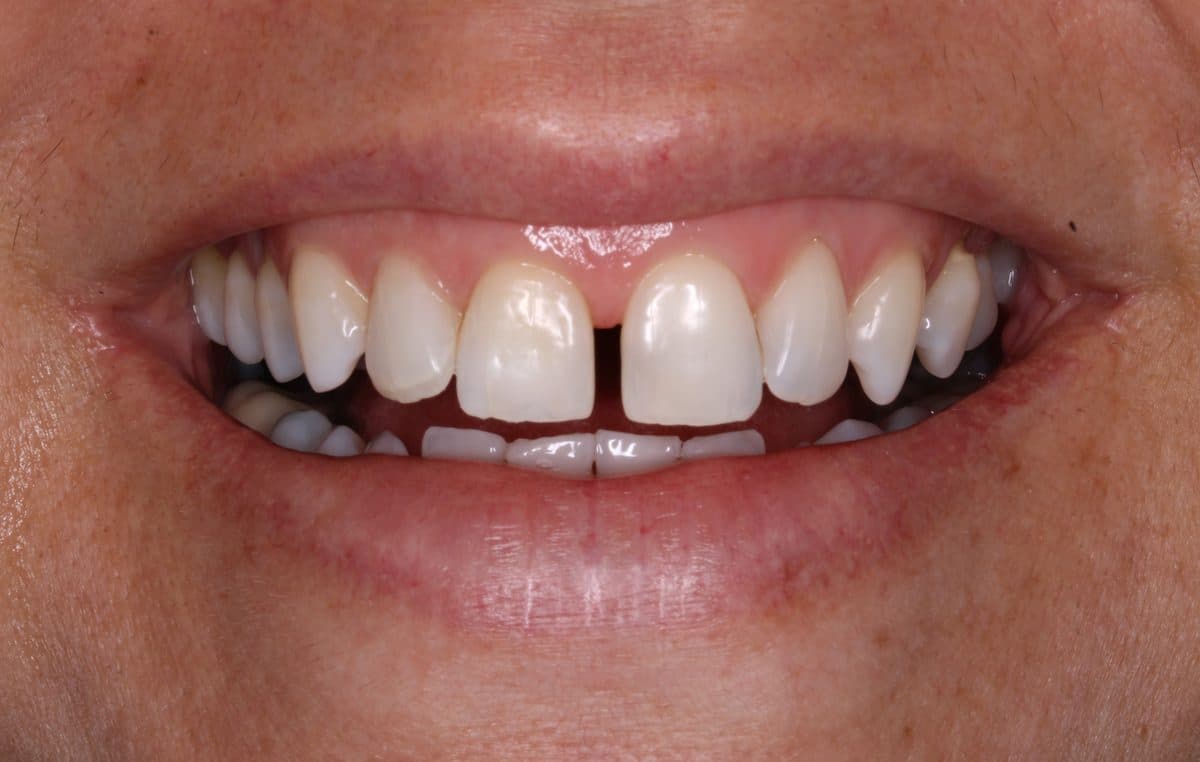 Smile with diastema before veneers